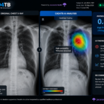 CAD4TB AI software interface showing a chest X-ray heatmap highlighting tuberculosis-suggestive abnormalities with an anomaly score.