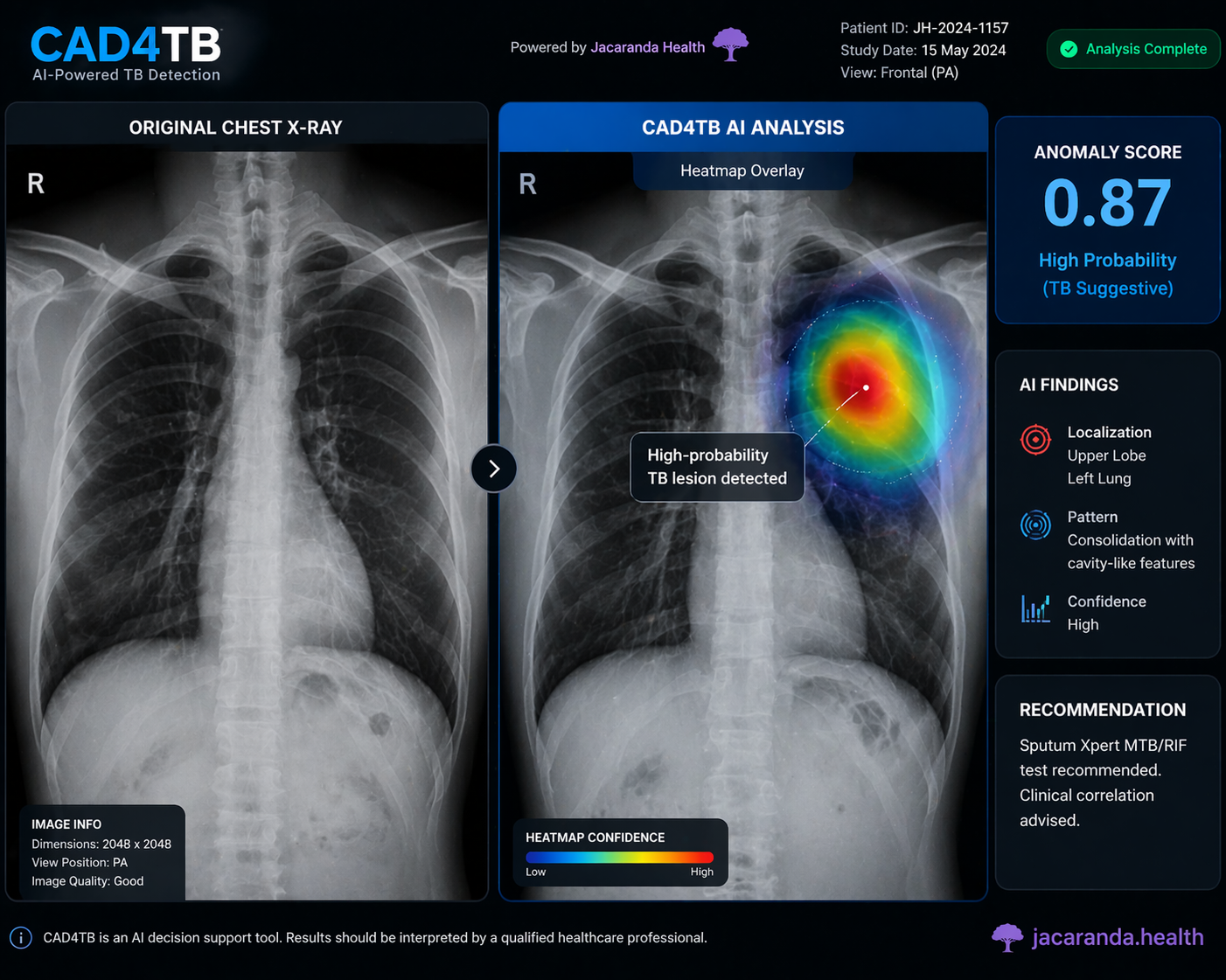 CAD4TB AI software interface showing a chest X-ray heatmap highlighting tuberculosis-suggestive abnormalities with an anomaly score.